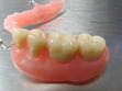 Dentures