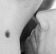 One Little Bruise