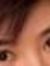 Sinusitis