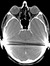 cochlearimplantHELP